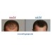 ยาปลูกผมและป้องกันผมร่วง รีเทน ไฟว์ (Minoxidil 5%)